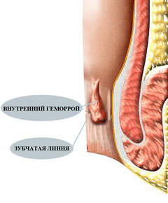 Внутренний геморрой - лечение в Севастополе